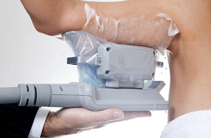 fat freezing arms Feltham