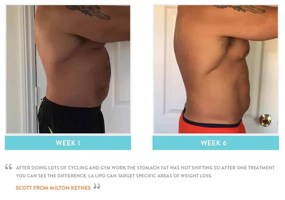 Before & After Stomach Fat Feltham