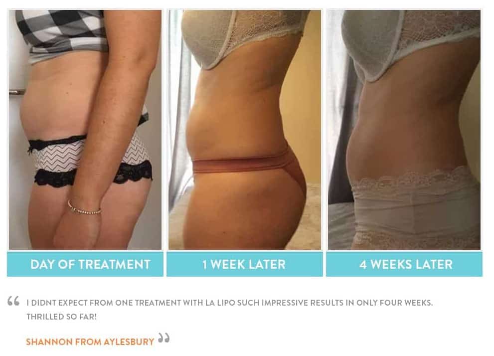 before, Cryolipolysis Feltham