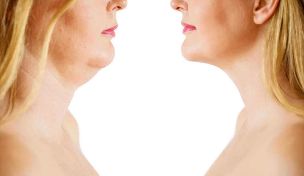 Double Chin treatment Feltham before and after results