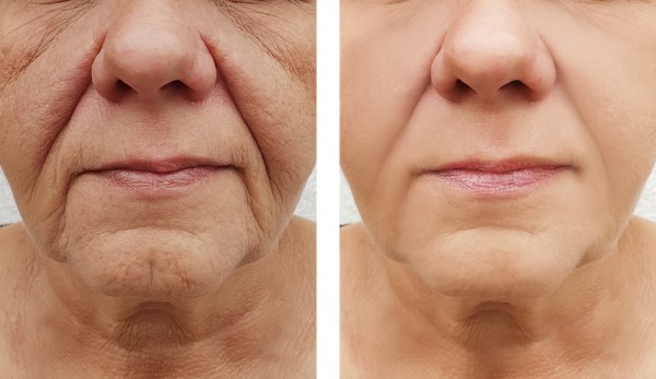 Learn more about Morpheus8 Treatment Feltham today!