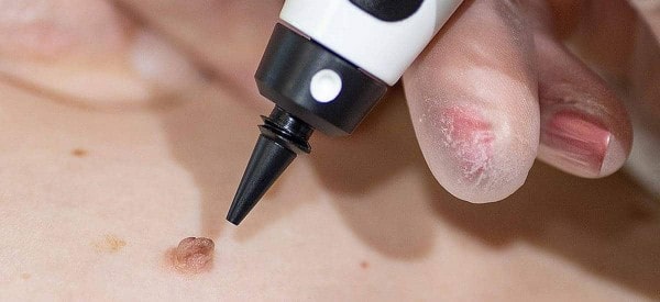 After Skin Tag Removal Feltham