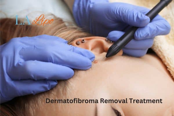 Dermatofibroma Removal Treatment Feltham