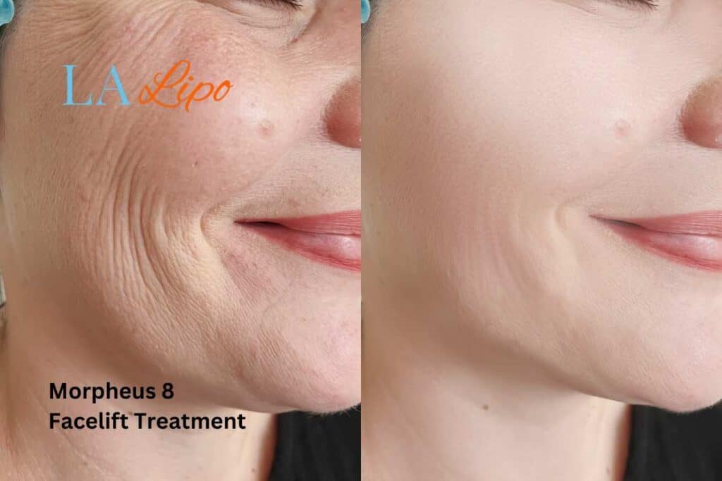 Morpheus8 Treatment Feltham for flawless skin! Call us today!
