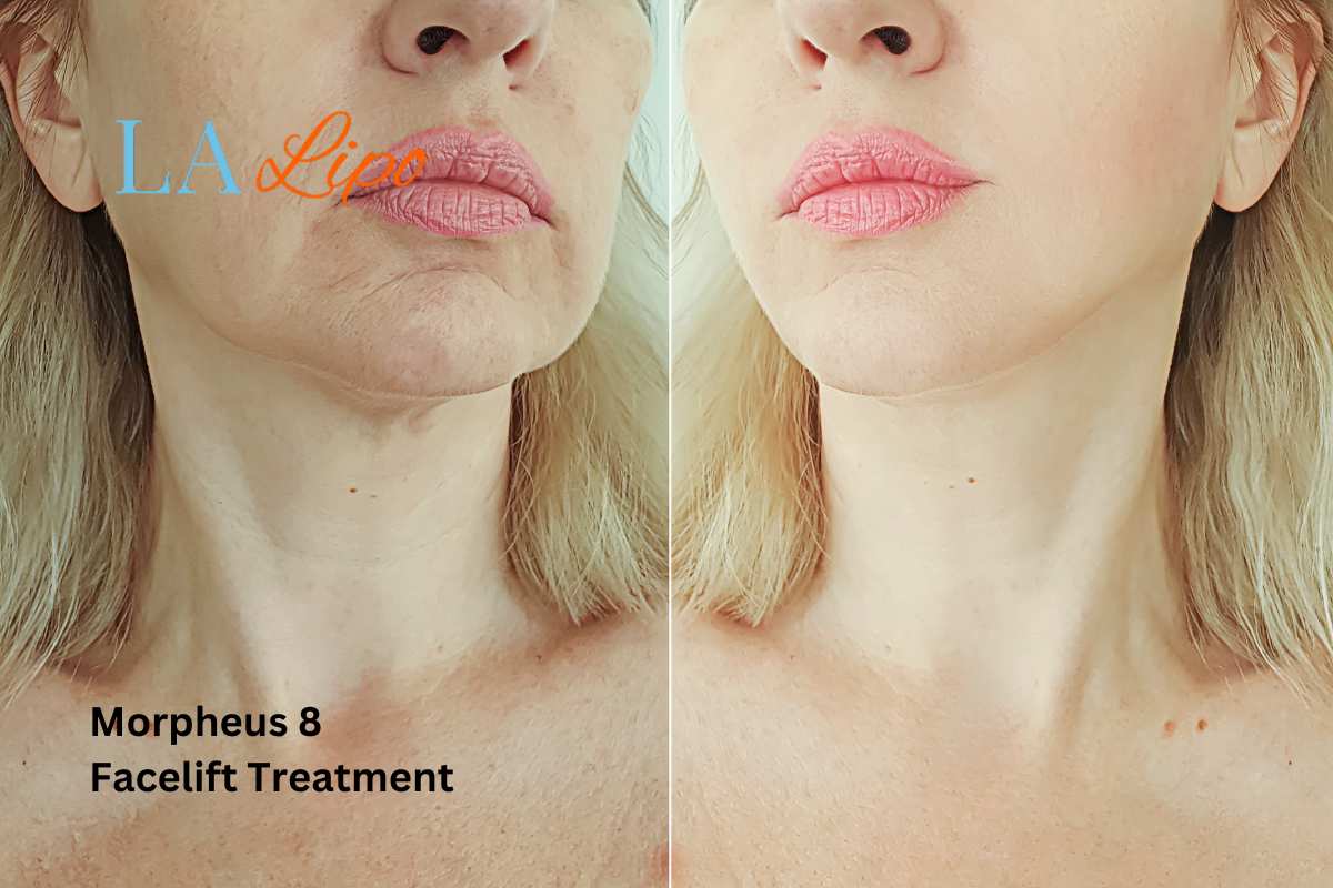 Turn back time with Morpheus8 Treatment Feltham