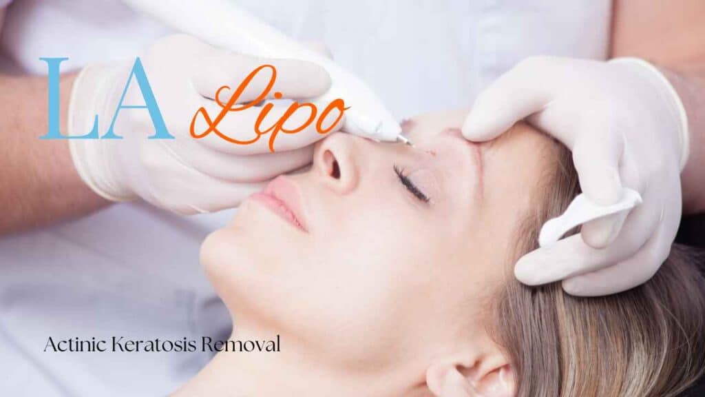 actinic keratosis removal Feltham