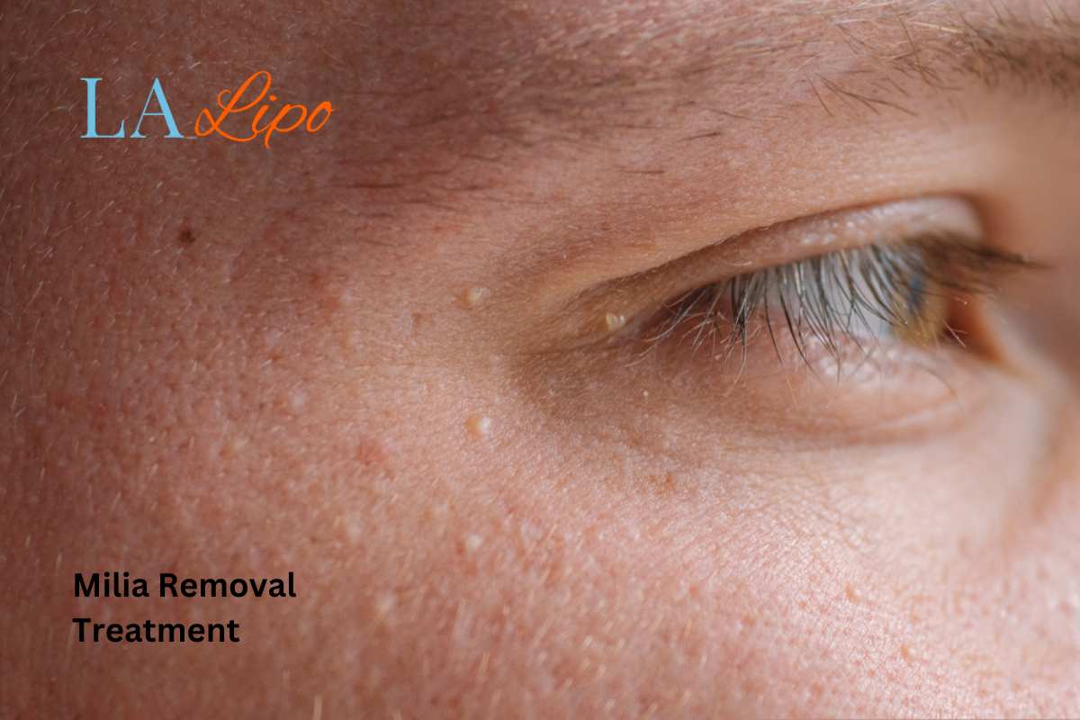 Cryopen Milia Removal: Is It the Easiest and Safest Option Feltham?