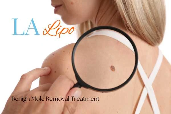 Woman having her inspection of blemish before mole removal Feltham