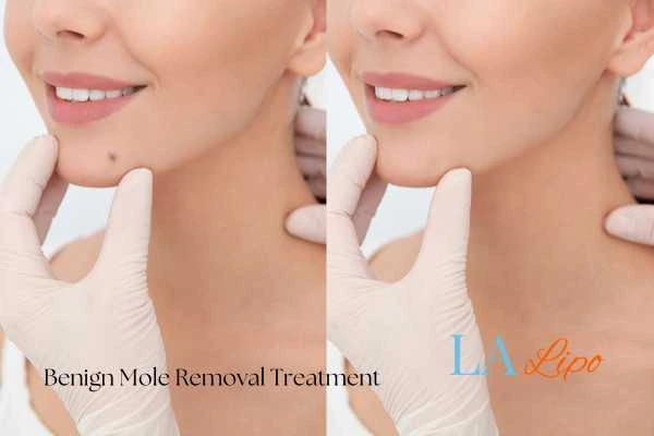woman's before and after mole removal Feltham results