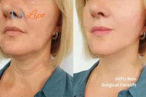 hi-fu for wrinkles Feltham before and after results