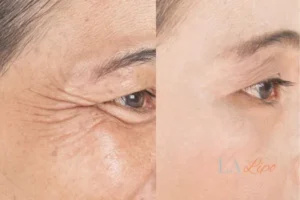 Before and after results of woman - HI-fu wrinkles reduction treatment Feltham