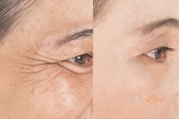 Before and after results of woman - HI-fu wrinkles reduction treatment Feltham
