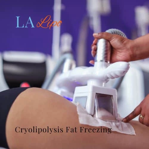 fat freezing - Cryolipolysis Feltham