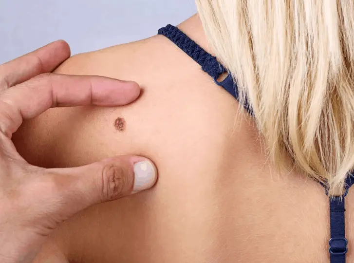 woman having mole removal Feltham consultation before treatment.