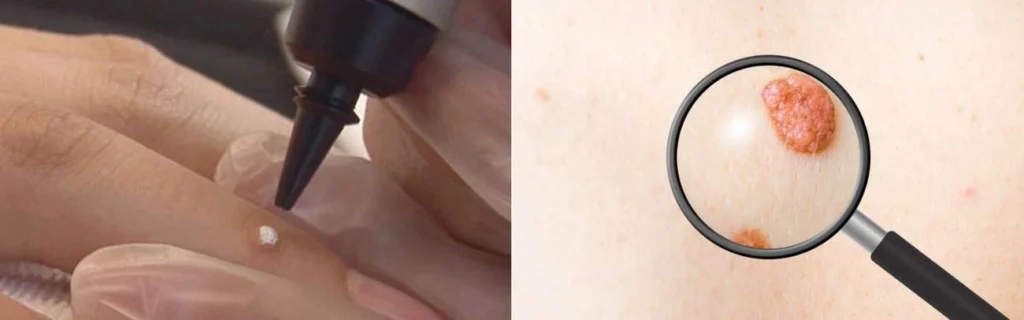 Person getting moles removed with cryopen Feltham