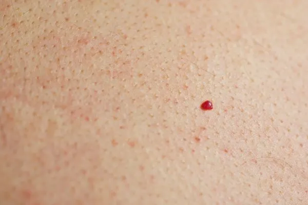 close up of a cherry angioma Feltham