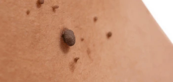 image of a skin tag Feltham