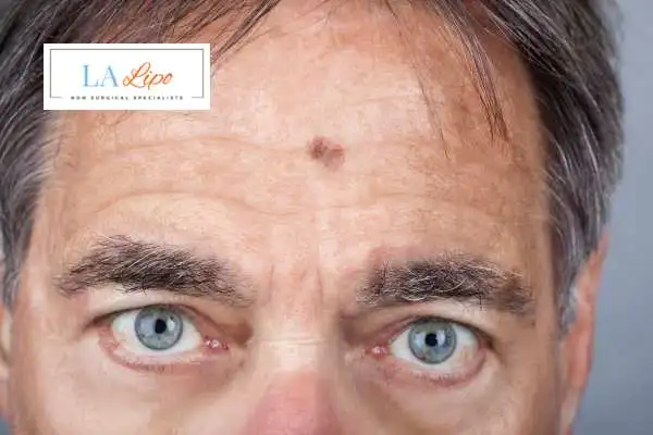 Solar Lentigo Removal Feltham image of man with mark on his forehead