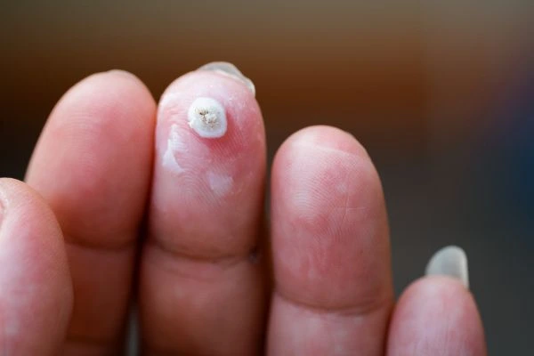 wart on person finger - cryotherapy to treat from LA LIPO Feltham