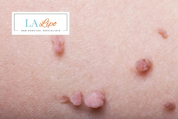 Does cryopen skin tag removal Feltham hurt? Find out now call our team today!