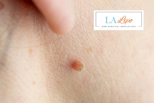 Book skin tag removal Feltham today speak to our team now!