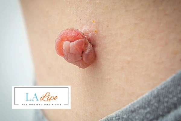 Interested in skin tag removal Feltham? Concerned about the pain? Find out more today!