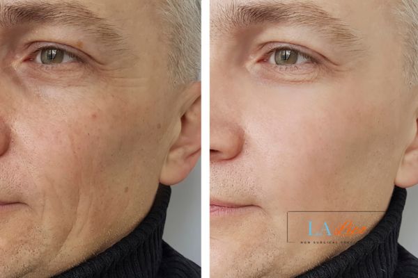 See the amazing results of Morpheus8 Treatment Feltham!