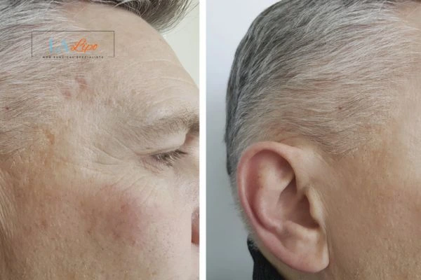 Mens Before & After Morpheus 8 Results Feltham