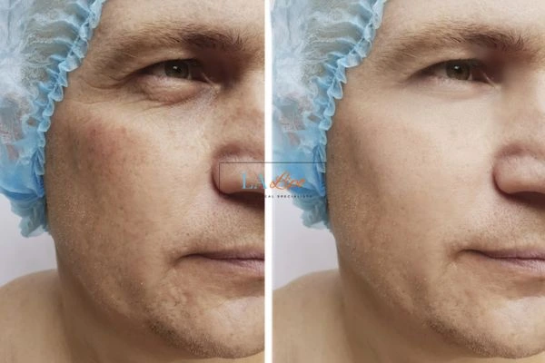 Before and after Morpheus 8 Results Feltham