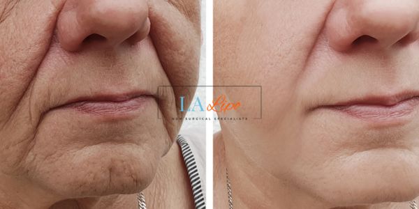 Older lady deeper wrinkle reduction - LA LIPO Morpheus 8 Results Feltham