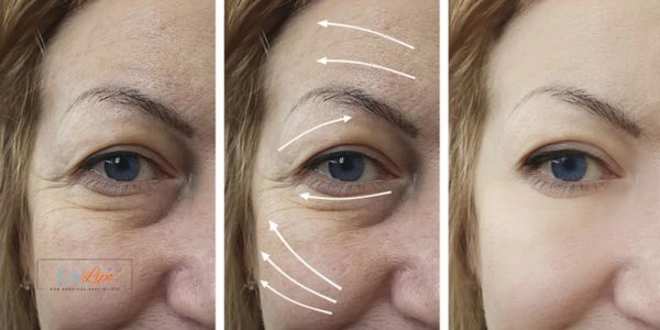 Amazing eye lift Morpheus 8 results Feltham
