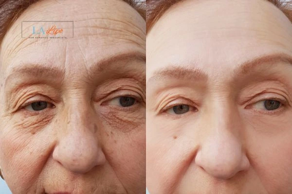 The powerful benefits of Morpheus8 Treatment Feltham - Call Our team today!