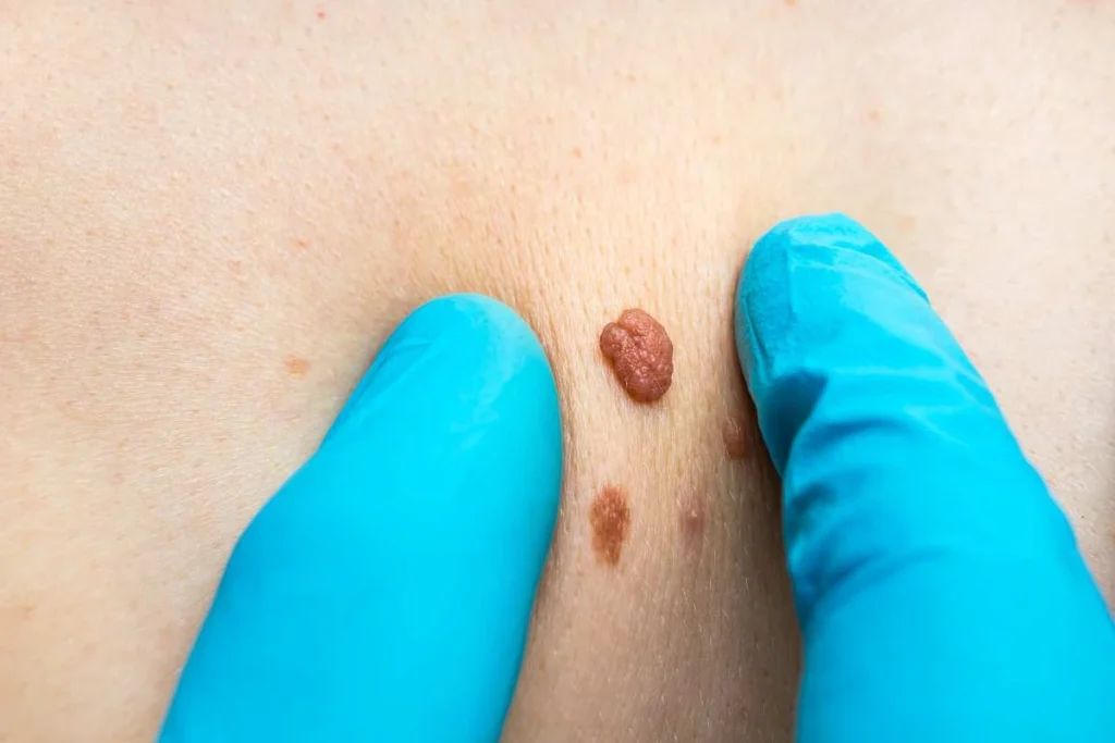LA LIPO Cryopen Lesion Removal Prices Feltham