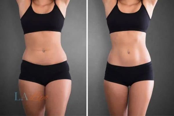before and after results of non-surgical treatment to help a woman's body image and mental health Feltham