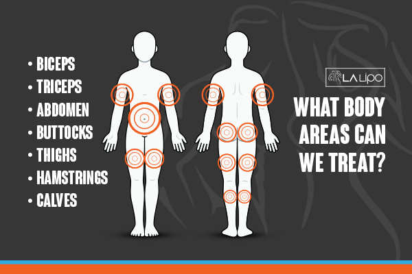Diagram to show areas you can have LA-EMS Body Sculpting Treatment Feltham