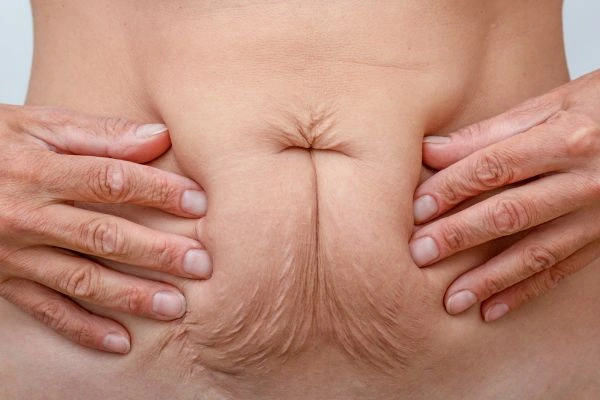 Image of a woman's stomach with loose skin - example of skin tightening Feltham options
