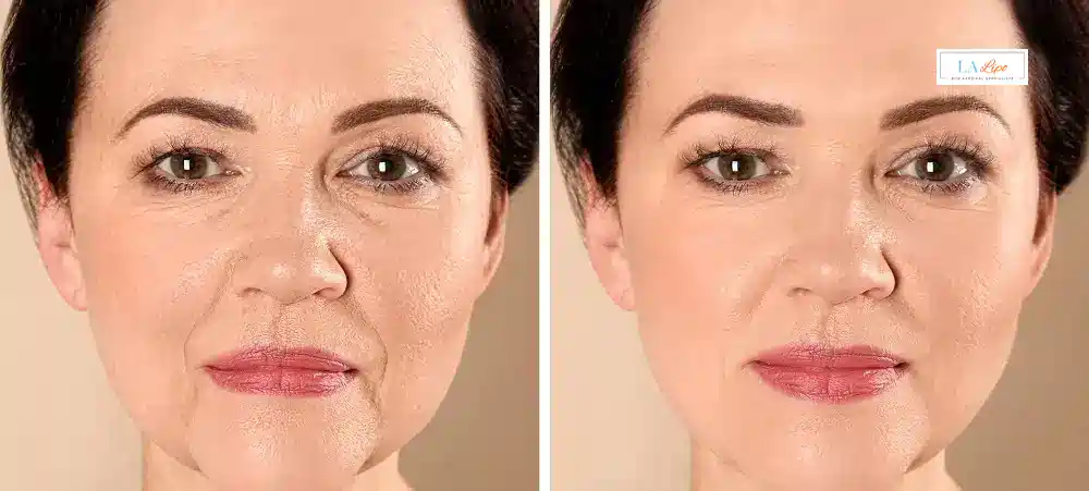 How Long Does It Take to See Results and How Long Do They Last Feltham?