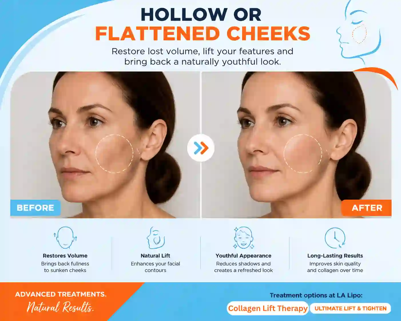 Sign #4: Hollow or Flattened Cheeks Feltham